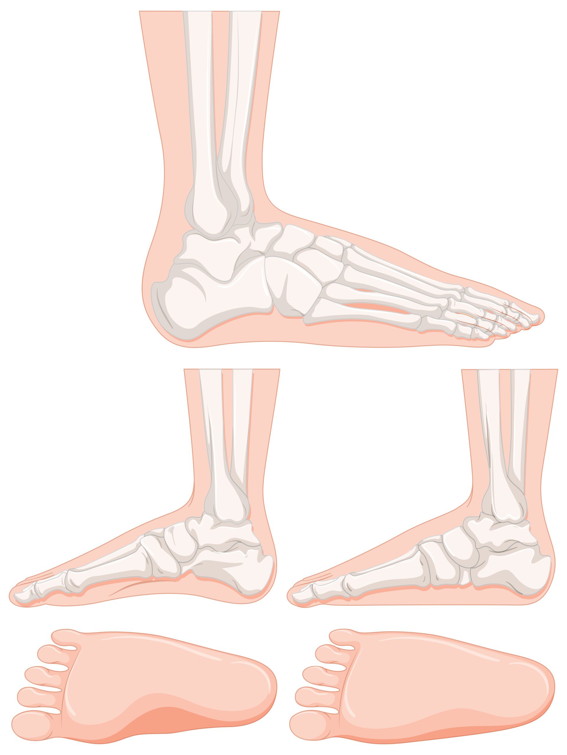 علاج القدم المسطحة: أسبابها وطرق علاجها