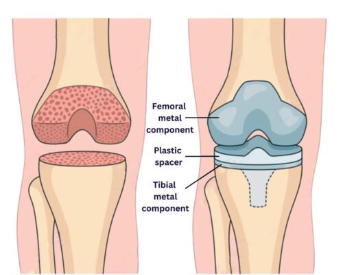 عملية تغيير مفصل الركبة - Credit: Astra Vein Treatment Center