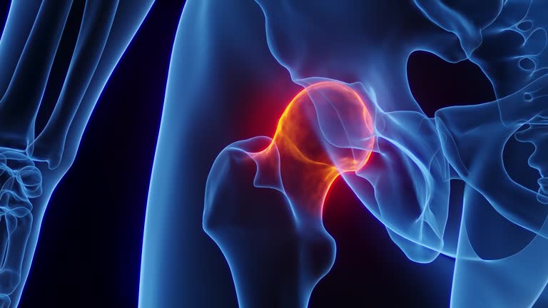 عملية استبدال مفصل الورك