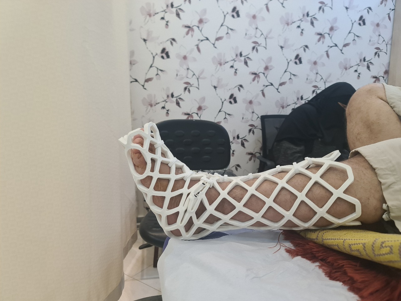 جبيرة اوبن كاست للقدم