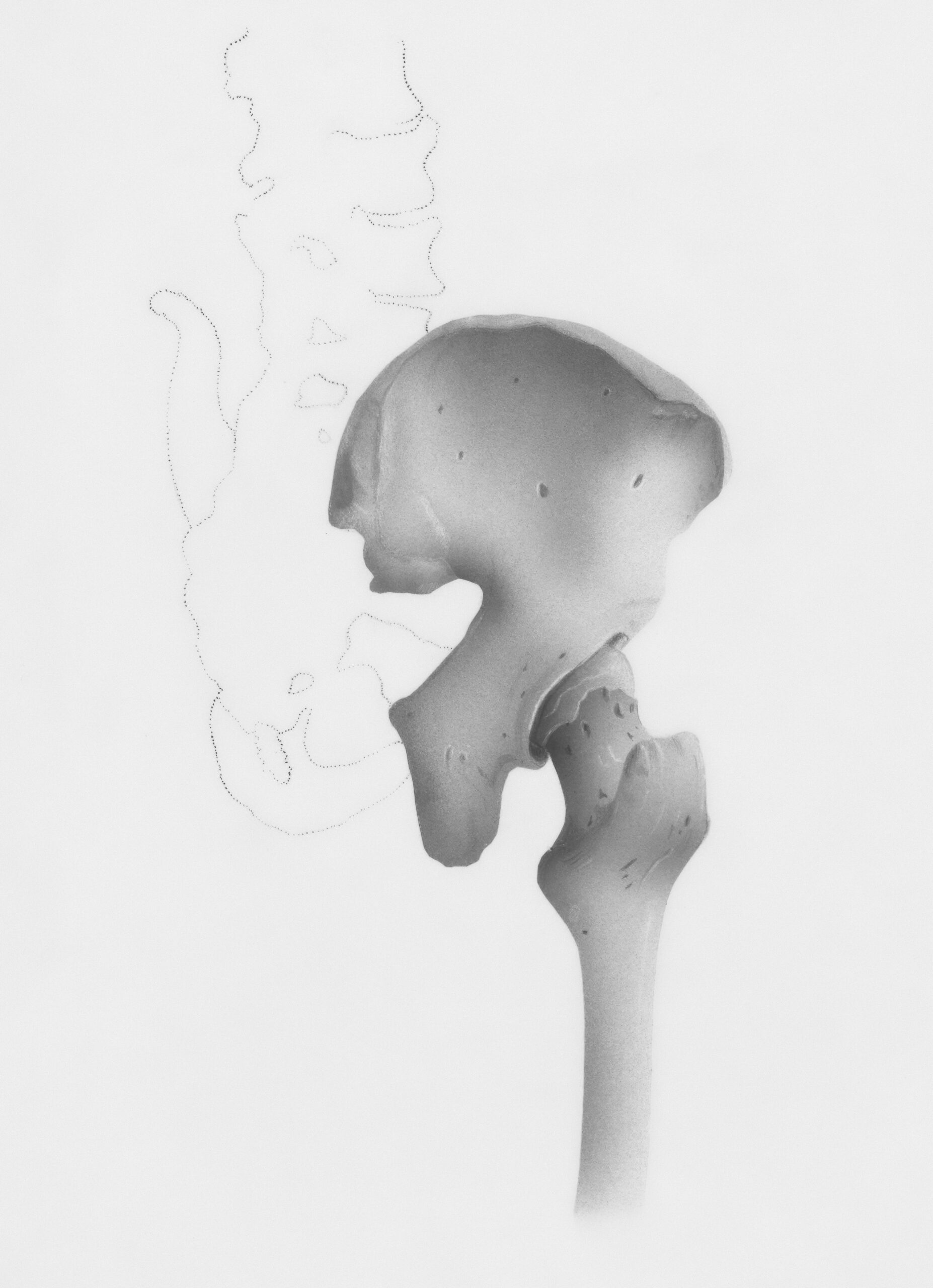 كل ما تحتاج لمعرفته عن عملية استبدال مفصل الورك